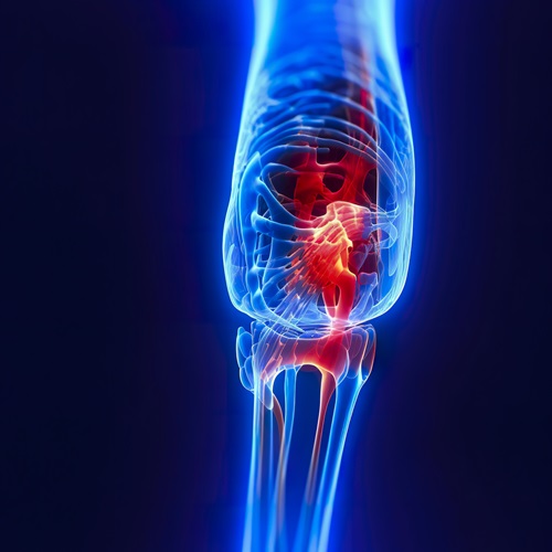 Starke schmerzen bei Arthritis im Kniegelenk