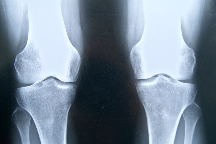 Röntgenaufnahme zeigt deutliche Arthritis in den Kniegelenken