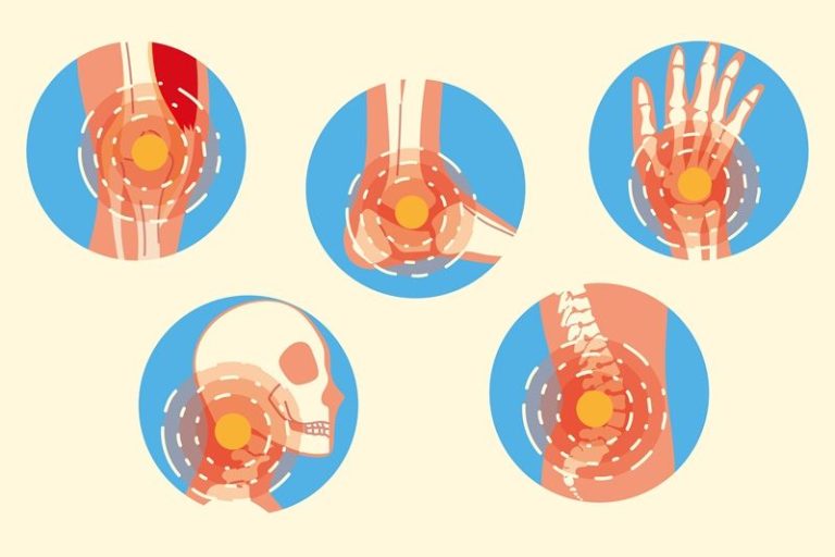 Arthritis ist eine entzündliche Erkrankung der Gelenke, die verschiedene Ursachen und Formen haben kann.